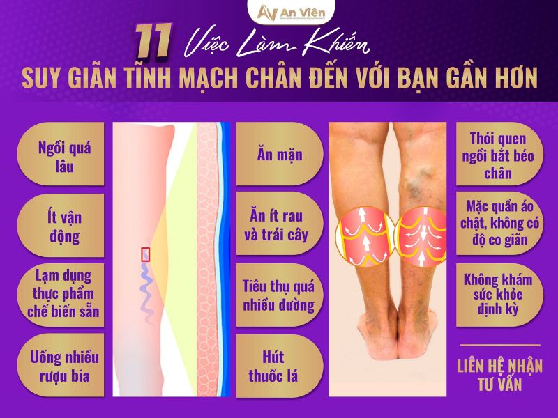 suy giãn tĩnh mạch bắp chân