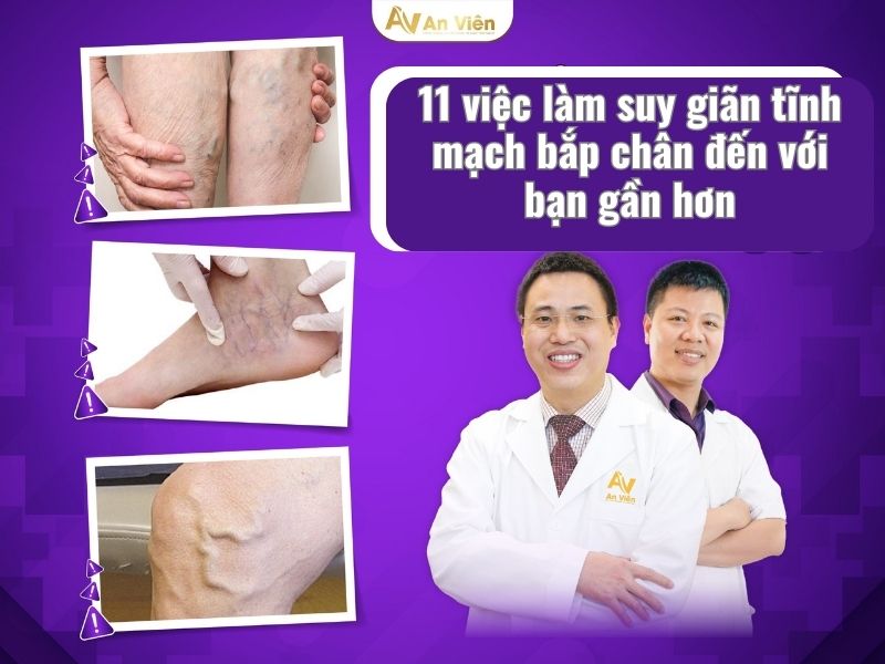 suy giãn tĩnh mạch bắp chân
