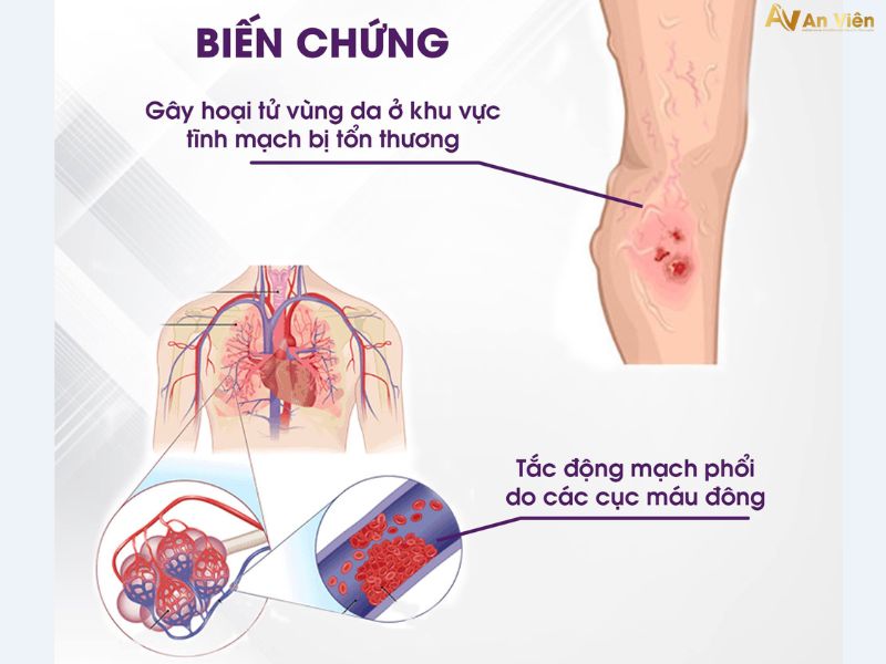 suy giãn tĩnh mạch có nguy hiểm không