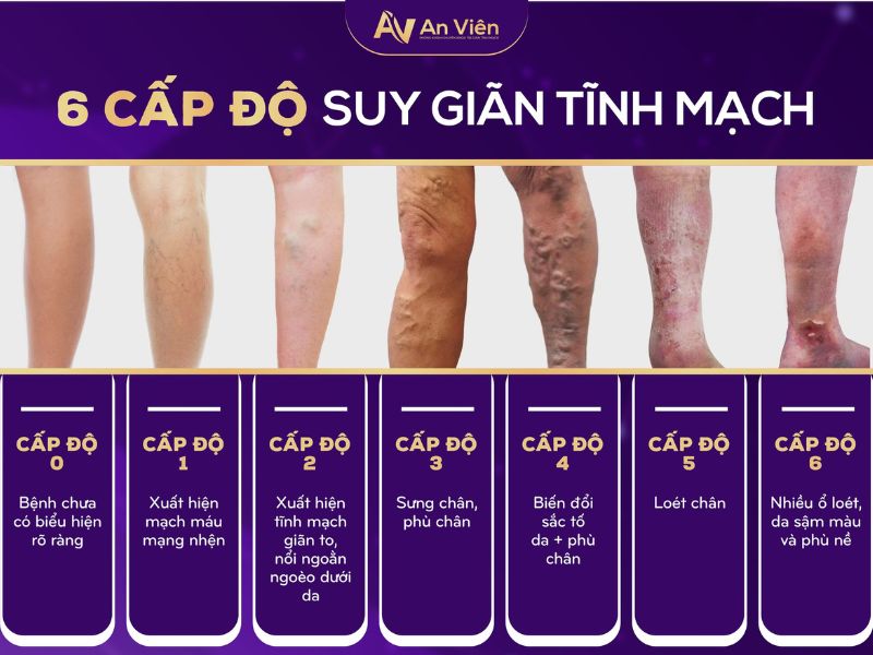 suy giãn tĩnh mạch có nguy hiểm không