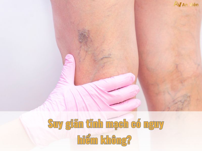 suy giãn tĩnh mạch có nguy hiểm không