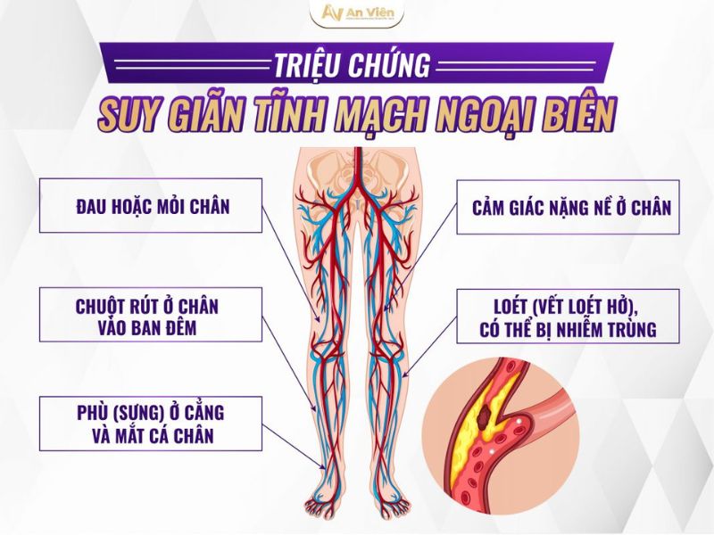 suy tĩnh mạch ngoại biên