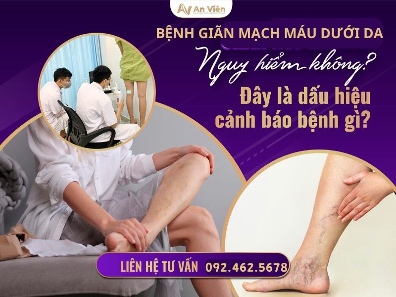 bệnh giãn mạch máu dưới da