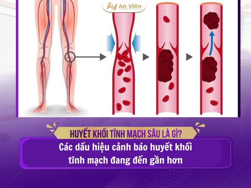 cách điều trị huyết khối tĩnh mạch