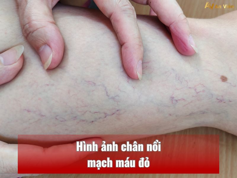 chân nổi mạch máu đỏ