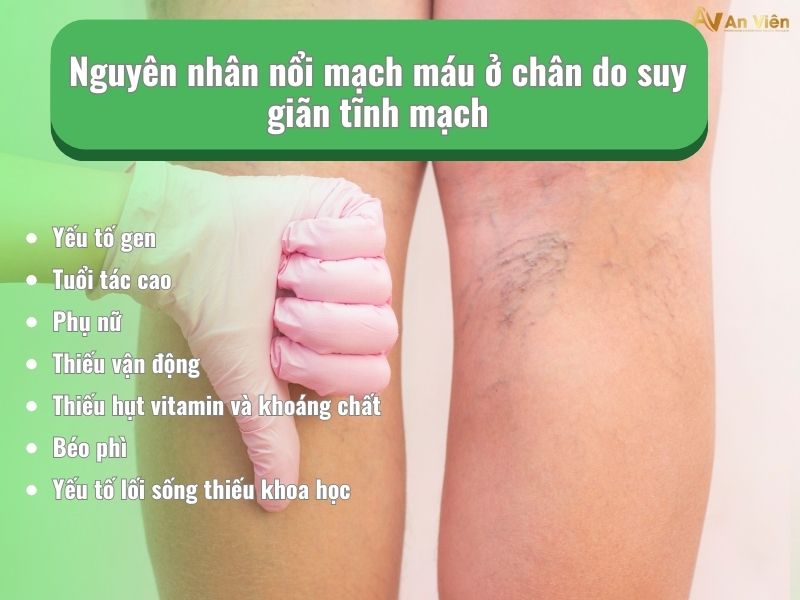 chân nổi mạch máu đỏ