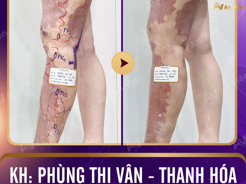 chân nổi mạch máu đỏ