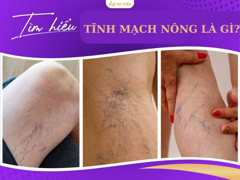 giãn tĩnh mạch nông chi dưới