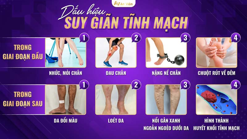 phác đồ điều trị suy giãn tĩnh mạch chân 1