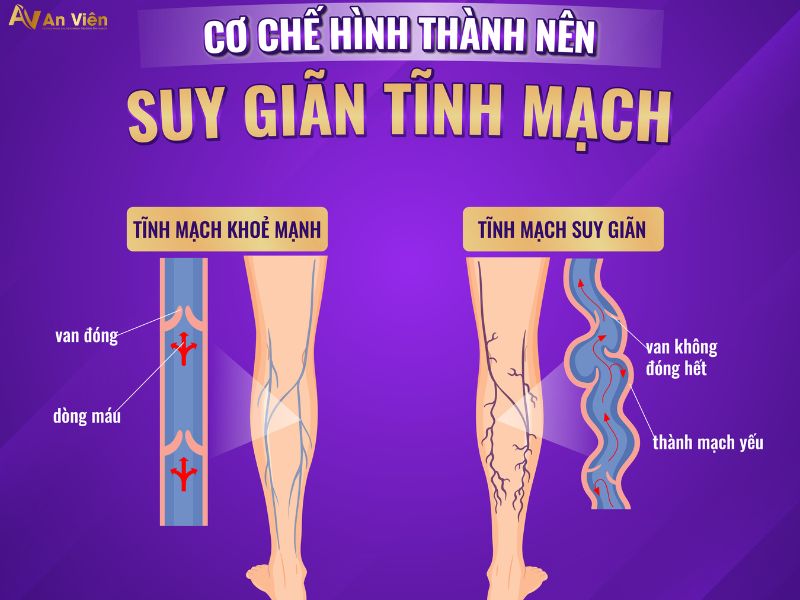 phòng giãn tĩnh mạch