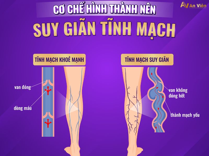 phồng tĩnh mạch chân