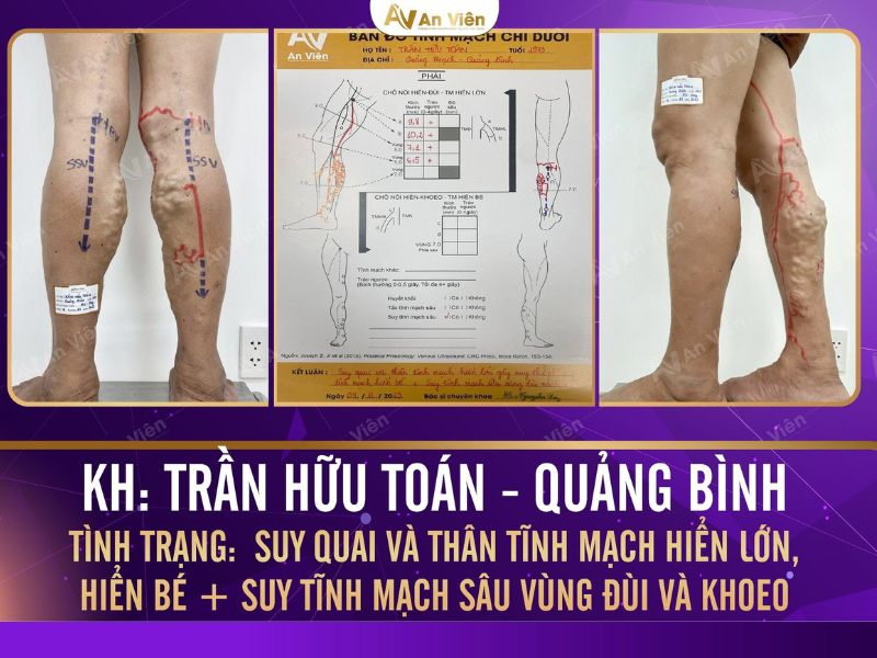 phồng tĩnh mạch chân