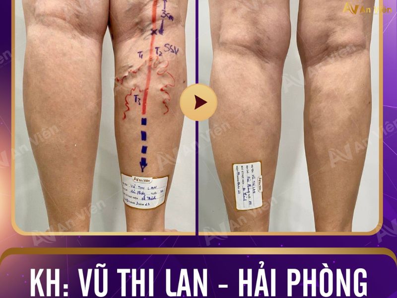 suy tĩnh mạch chi dưới 