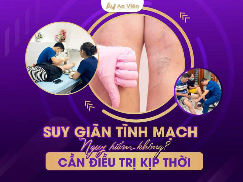 suy tĩnh mạch chi dưới điều trị
