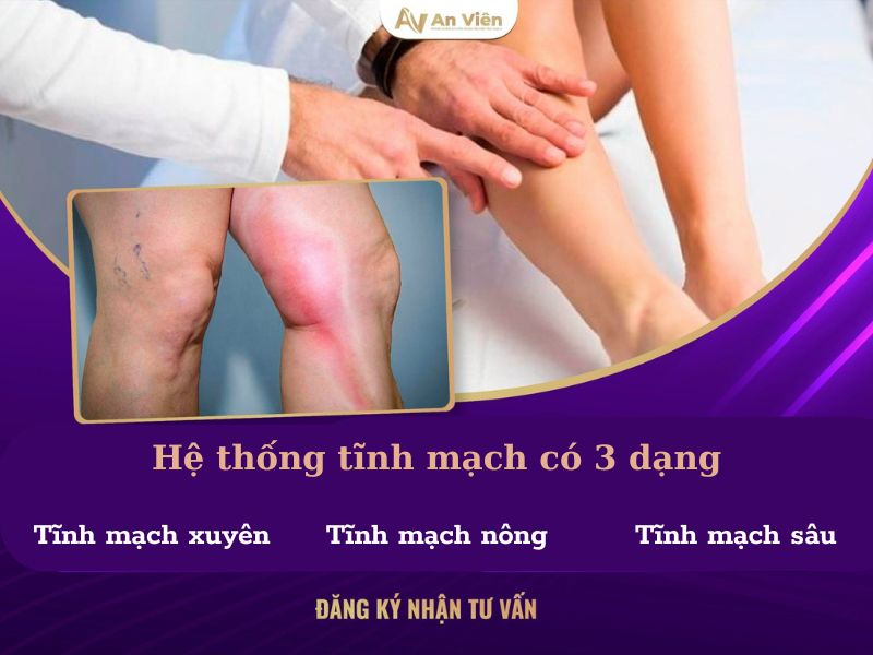 suy van tĩnh mạch hiển lớn là gì