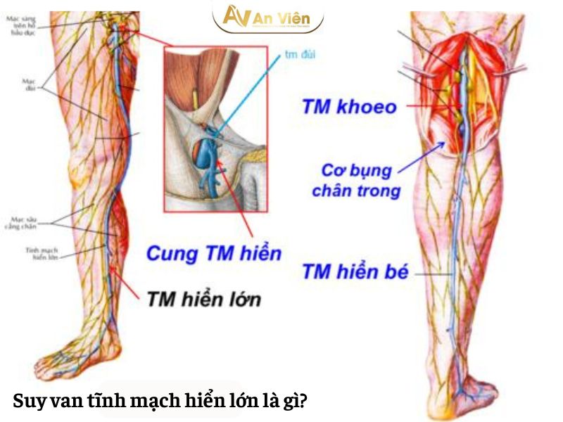 suy van tĩnh mạch hiển lớn là gì