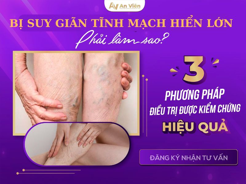 suy van tĩnh mạch hiển lớn là gì
