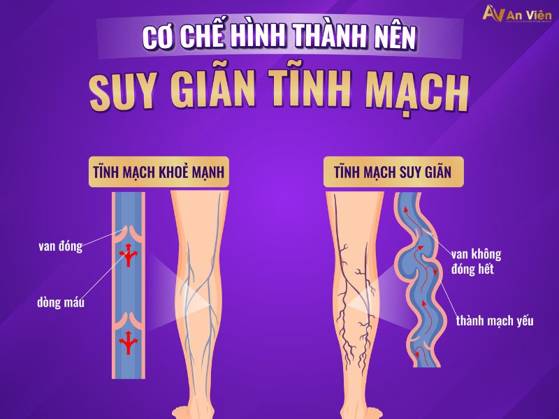 trị giãn tĩnh mạch chân