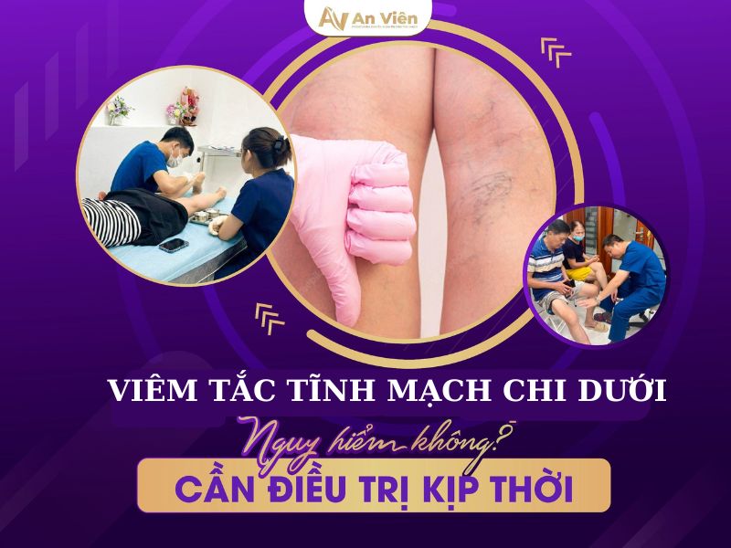 viêm tĩnh mạch chi dưới