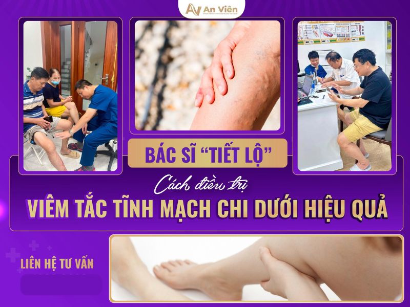 viêm tĩnh mạch chi dưới