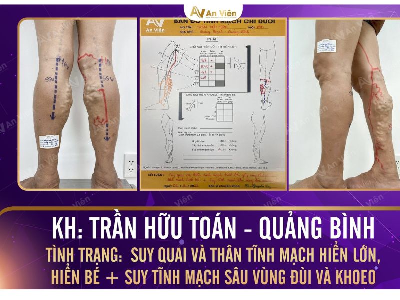 bệnh giãn tĩnh mạch chân khám ở đâu