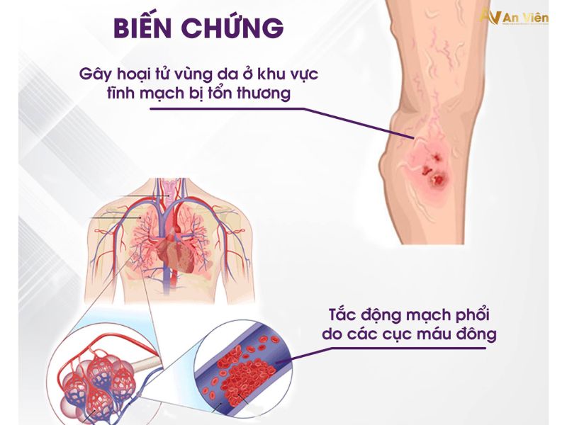 bệnh suy giãn tĩnh mạch có nguy hiểm không