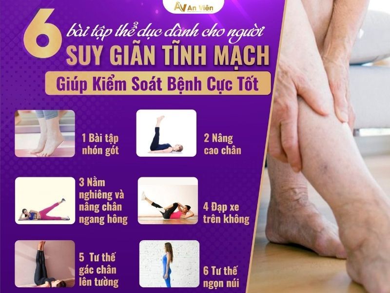 cách ngăn ngừa giãn tĩnh mạch