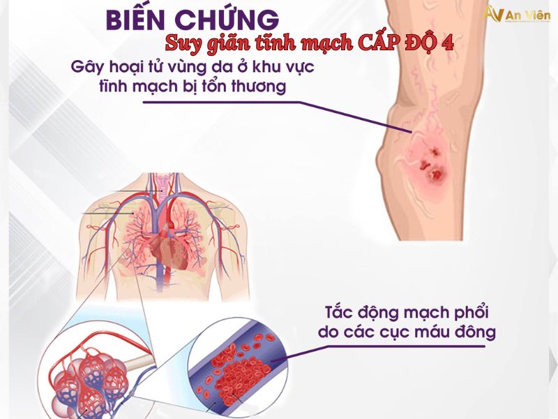 chữa bệnh suy giãn tĩnh mạch