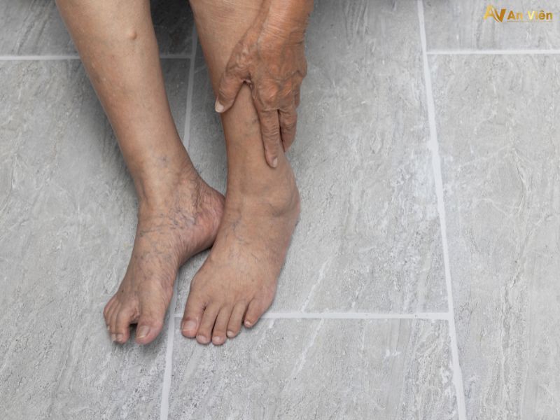 chữa bệnh suy giãn tĩnh mạch chân