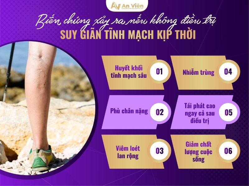 giãn tĩnh mạch chân nguyên nhân