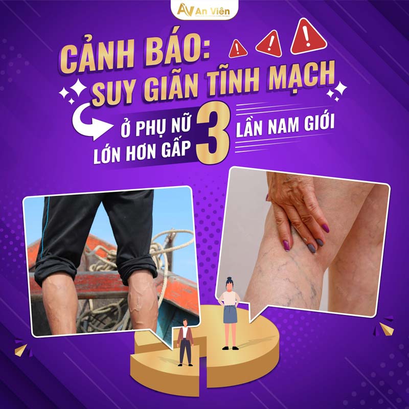 giãn tĩnh mạch chân nguyên nhân