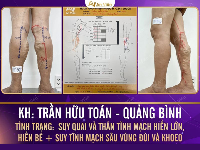 giãn tĩnh mạch chườm nóng hay lạnh