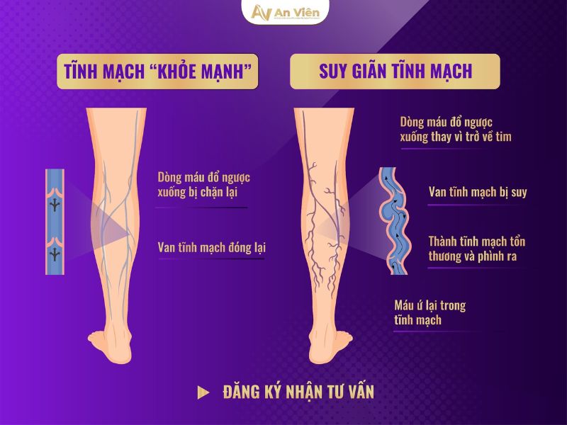 giãn tĩnh mạch chườm nóng hay lạnh