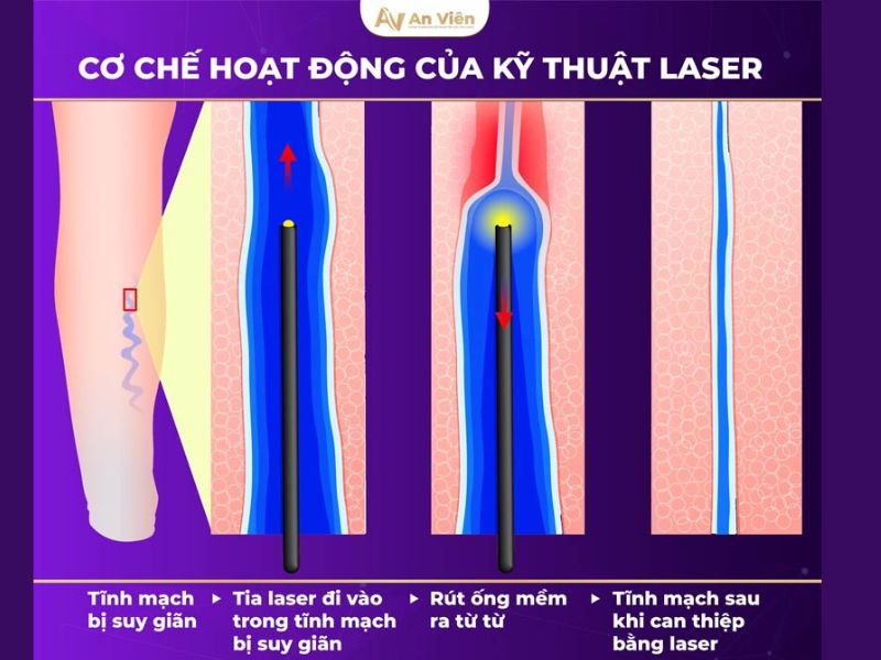 giãn tĩnh mạch chườm nóng hay lạnh