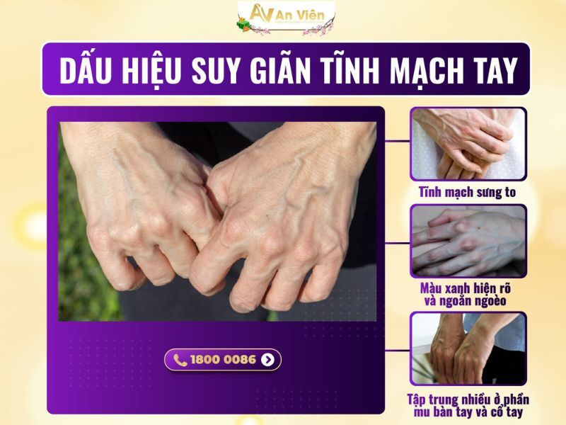 giãn tĩnh mạch ở bắp tay