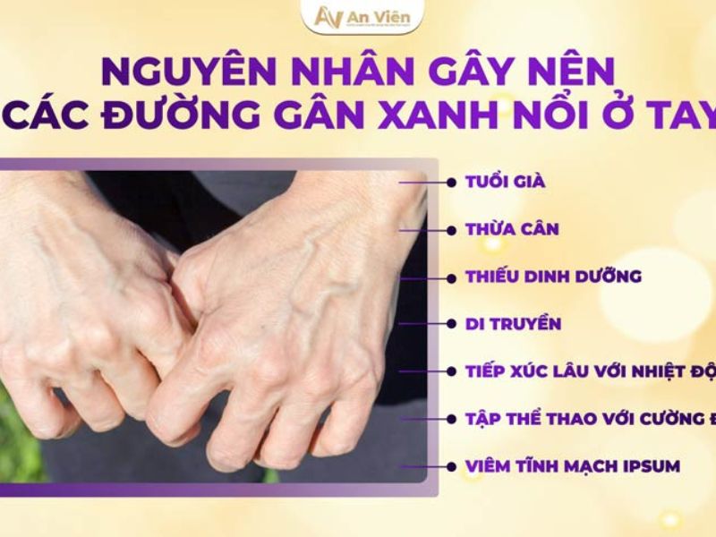 giãn tĩnh mạch ở tay