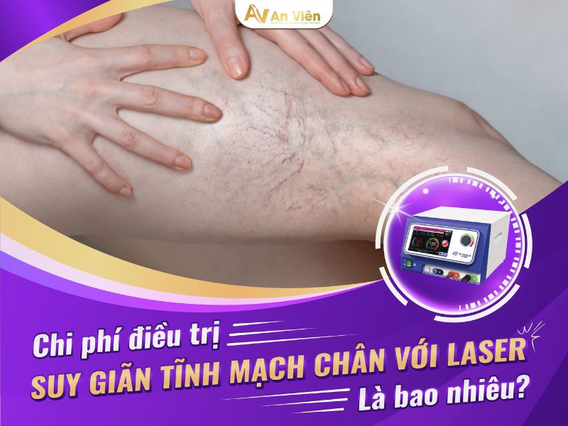 mổ giãn tĩnh mạch chân hết bao nhiêu tiền