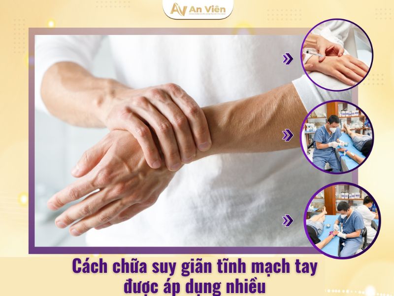 suy giãn tĩnh mạch tay