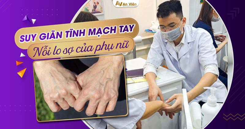suy giãn tĩnh mạch tay