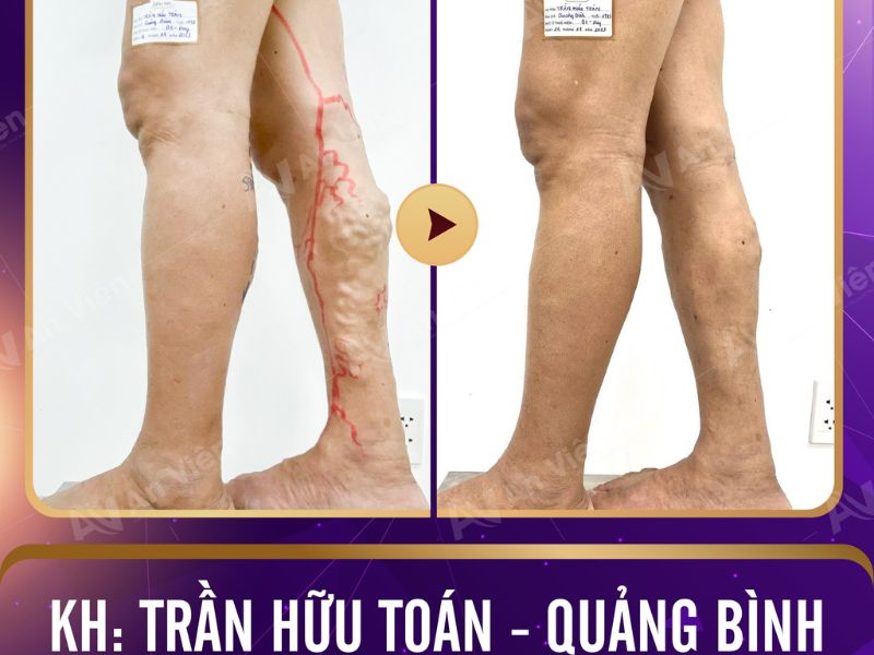 triệu chứng giãn tĩnh mạch chân