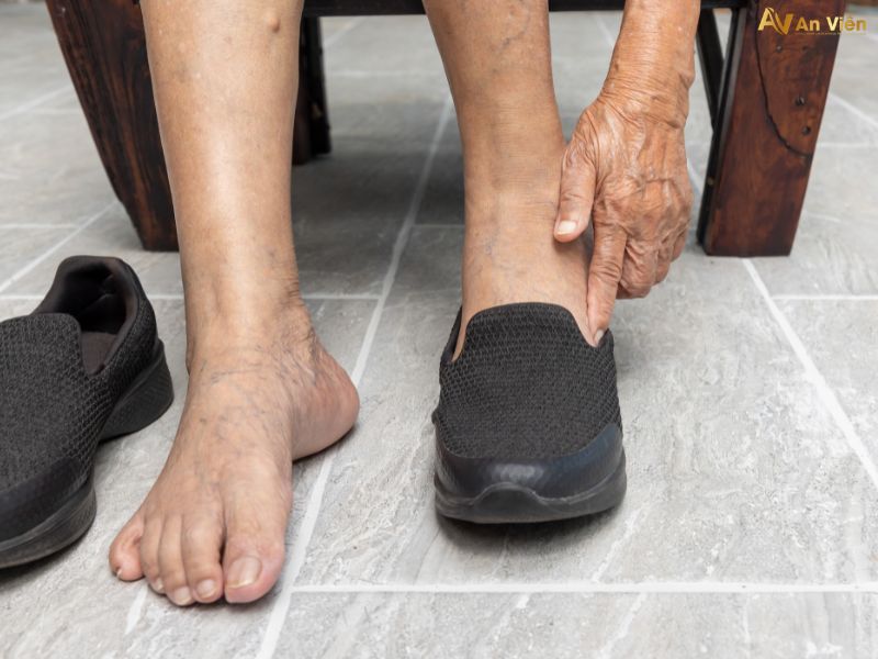 triệu chứng giãn tĩnh mạch chân