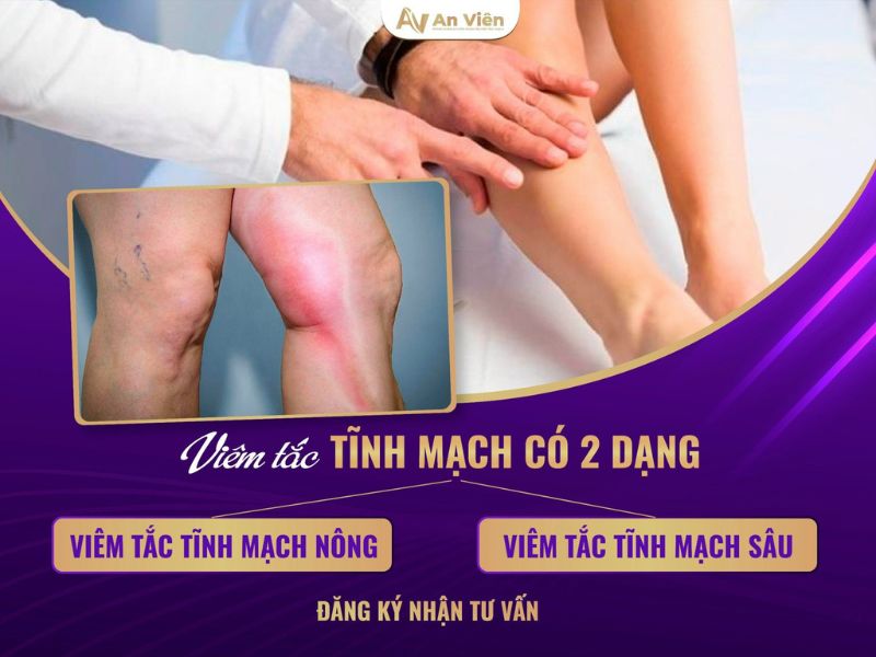 viêm tĩnh mạch là gì