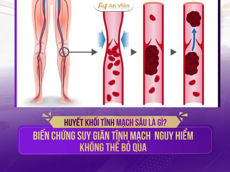 viêm tĩnh mạch là gì