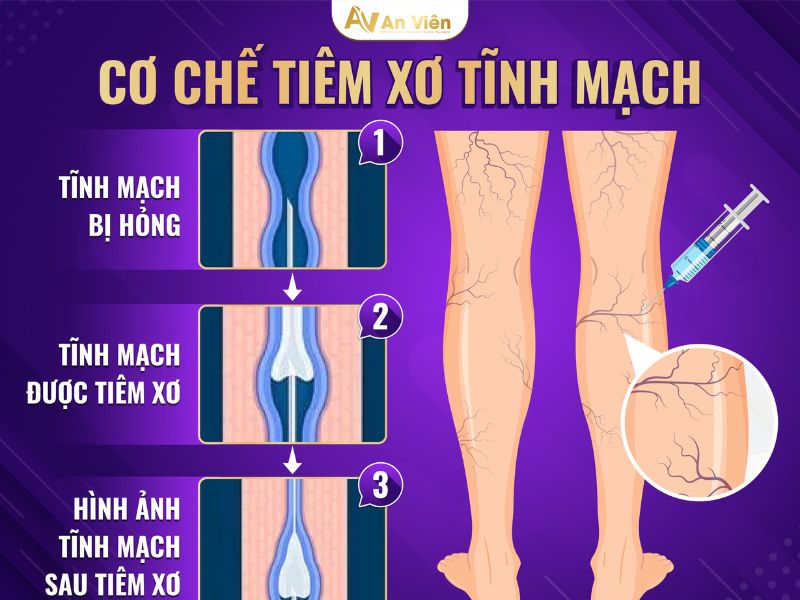tiêm xơ giãn tĩnh mạch giá bao nhiêu