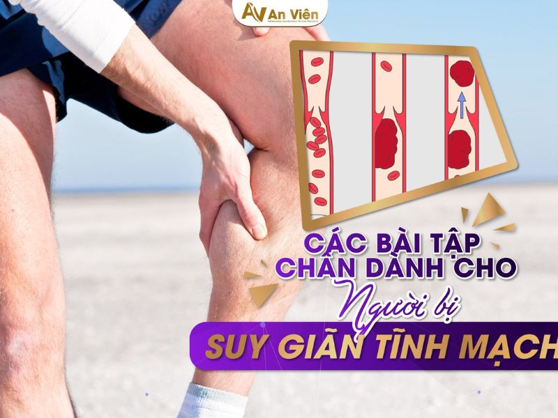 bị giãn tĩnh mạch ở chân phải làm sao