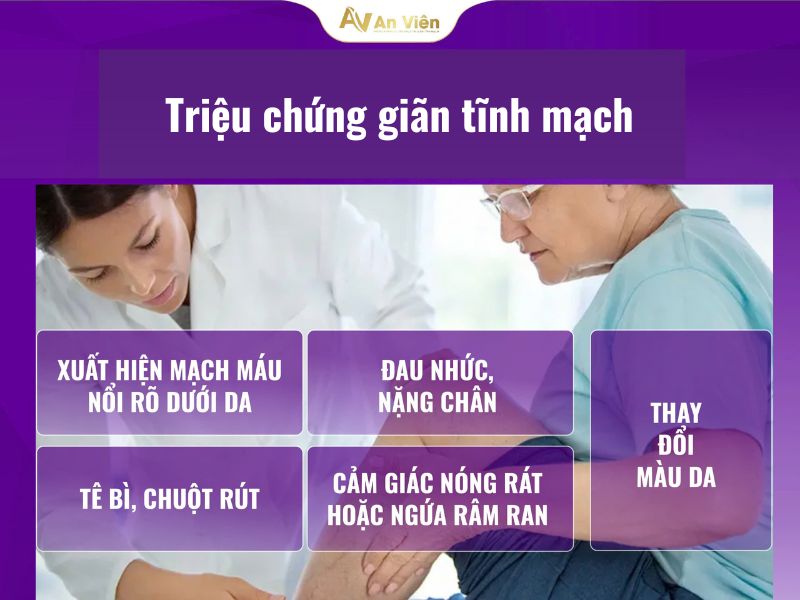 cách trị giãn tĩnh mạch chân tại nhà