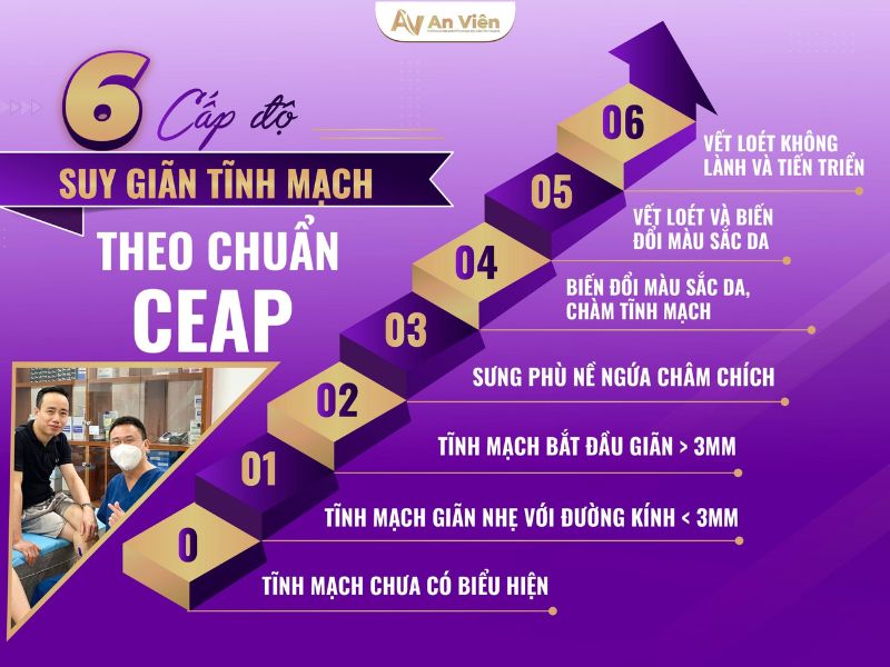 cách điều trị giãn tĩnh mạch chân tại nhà
