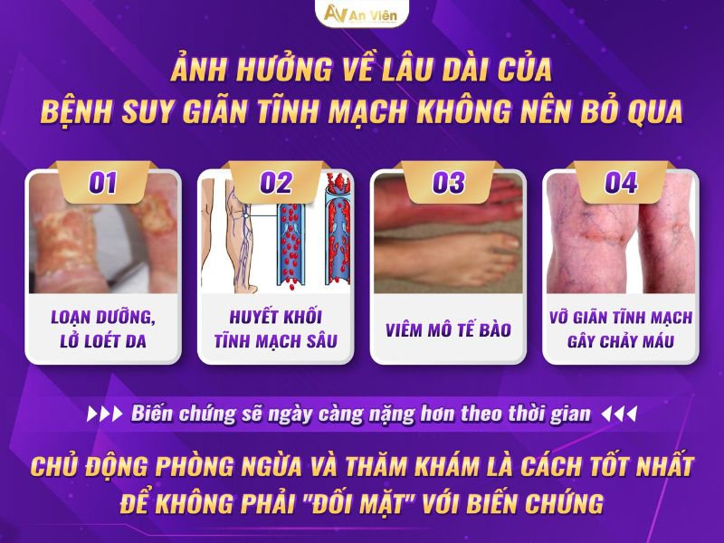 cách trị suy giãn tĩnh mạch