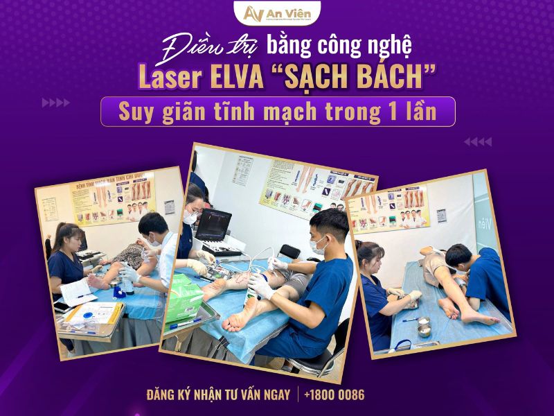 cách trị suy giãn tĩnh mạch