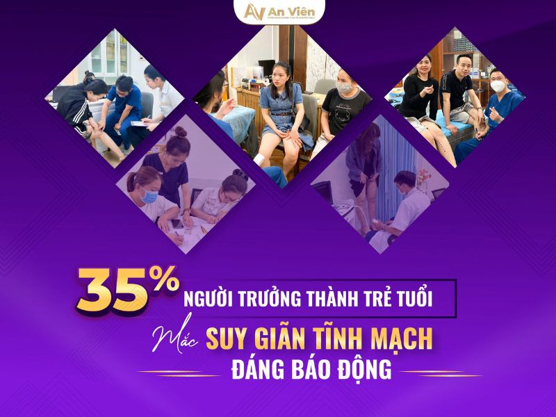 chữa suy giãn tĩnh mạch chân